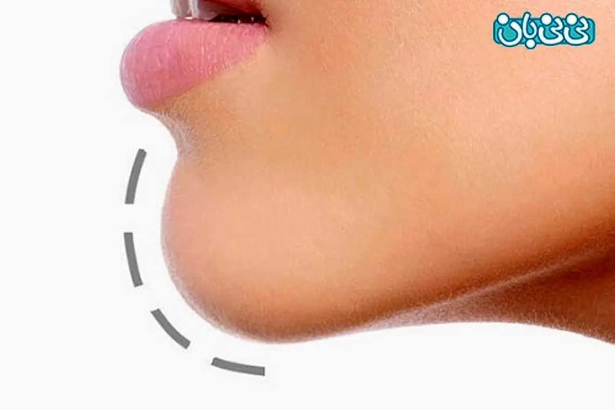 بازسازی فک پایین، چه روشهایی دارد؟