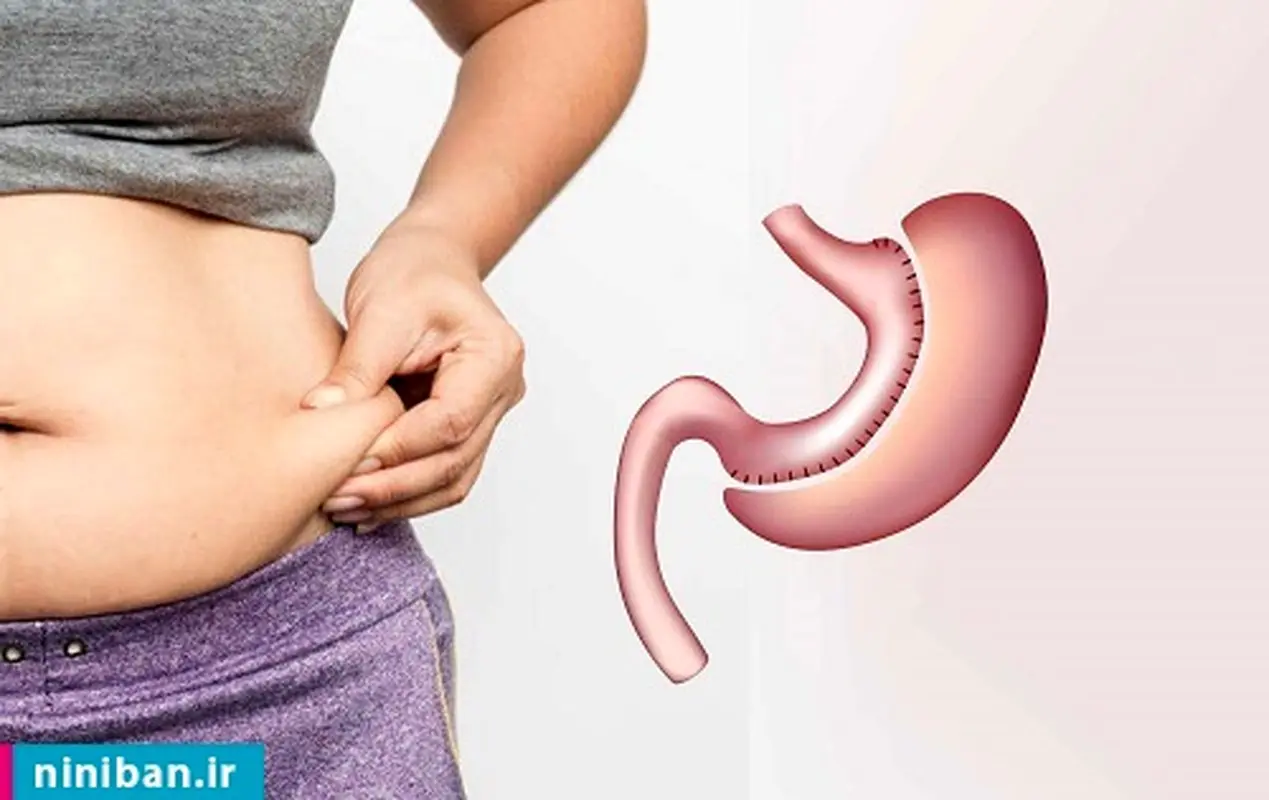 لاغری با مینی بای ‌‌پس، چقدر این روش مؤثره؟