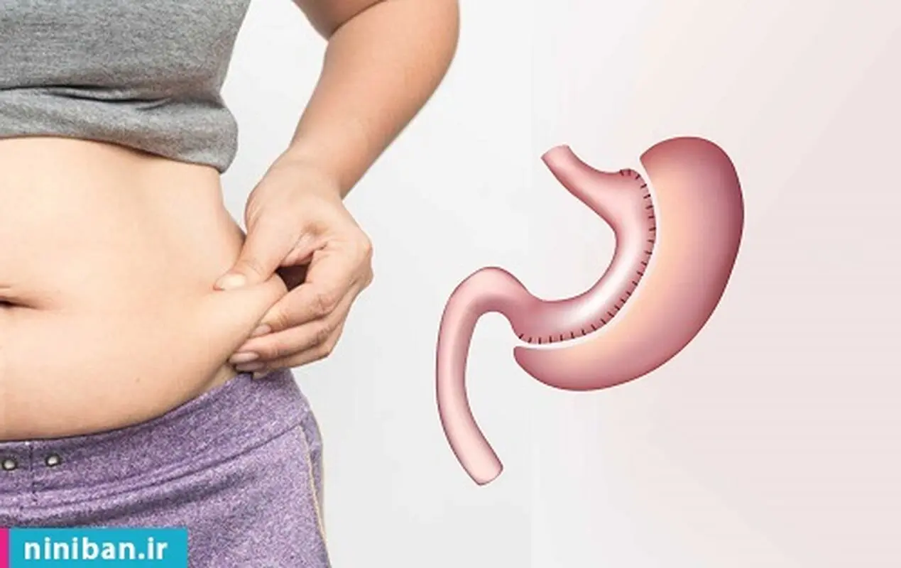 لاغری با مینی بای ‌‌پس، چقدر این روش مؤثره؟