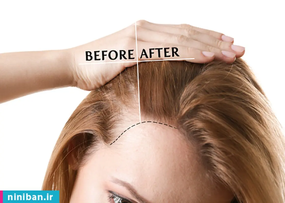 پروتز مو بهتر است یا کاشت مو؟