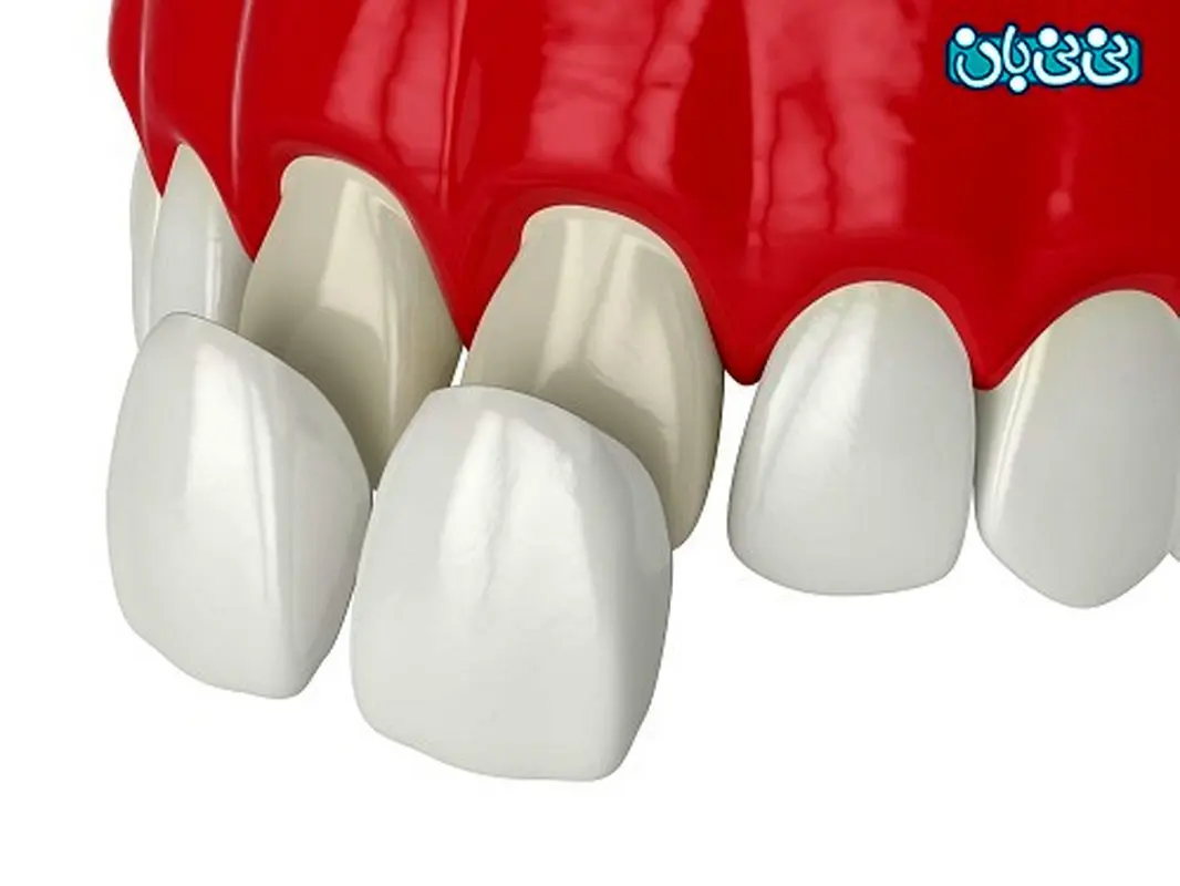 همه چیز درباره لمینت دندان و روش های آن، مزایا و عوارض تا محدودیتها