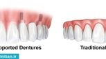 قیمت دندان مصنوعی با پایه ایمپلنت