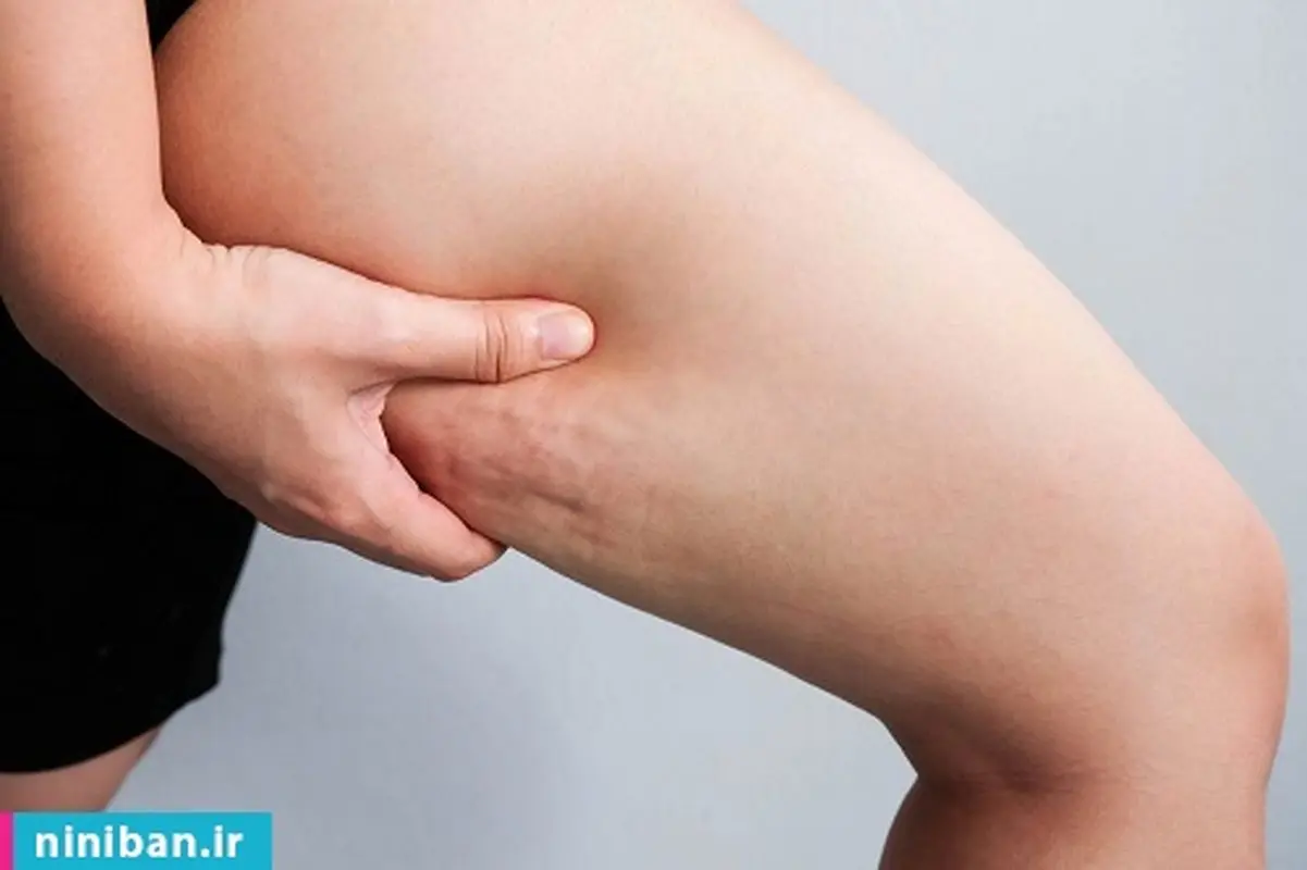 جدیدترین روش لاغری برای رفع سلولیت، واقعا تاثیر داره؟