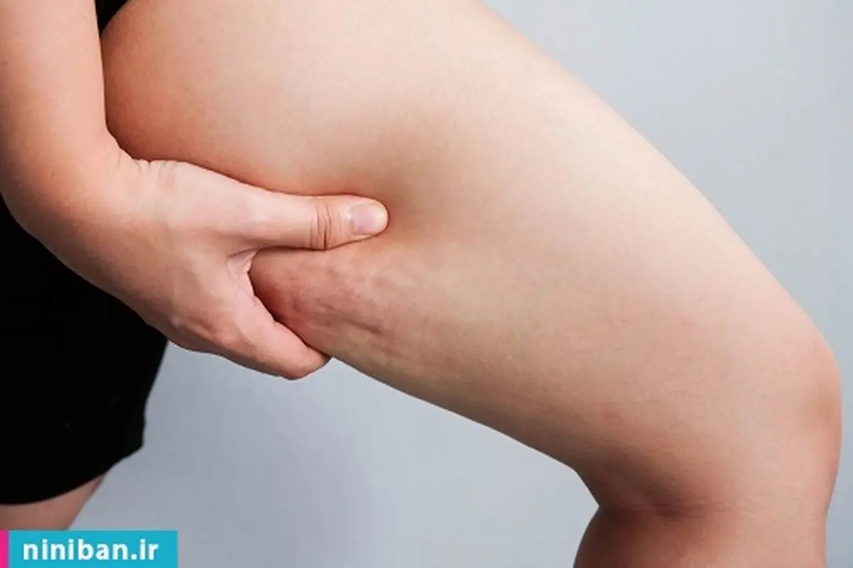 جدیدترین روش لاغری برای رفع سلولیت، واقعا تاثیر داره؟