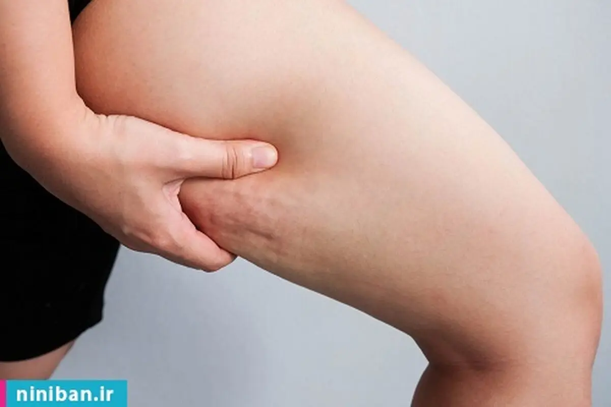 جدیدترین روش لاغری برای رفع سلولیت، واقعا تاثیر داره؟