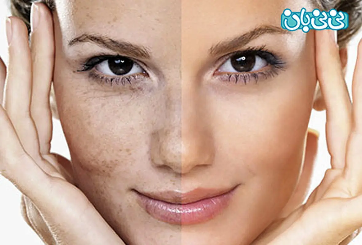 روش‌های از بین بردن لکه های قهوه ای جای جوش چیست؟