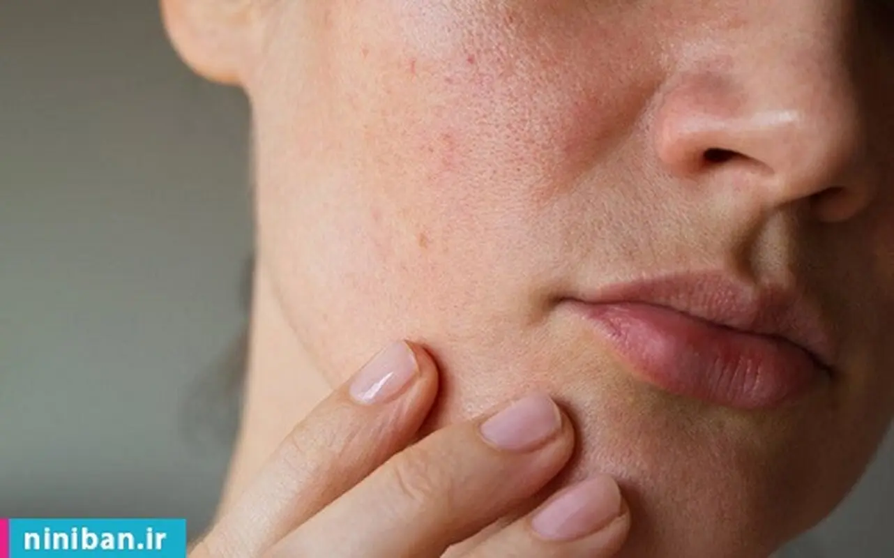 تاثیر سرما بر پوست؛ برای محافظت از پوست چه باید کرد؟