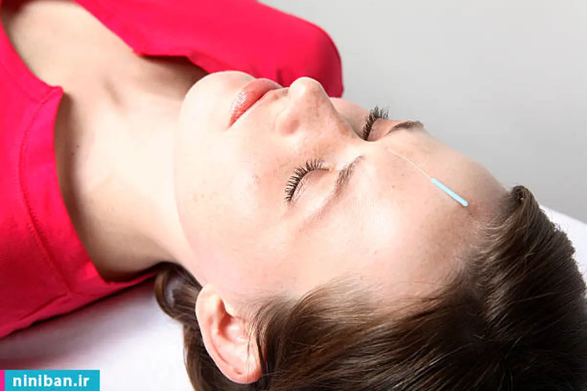 چاق شدن صورت با طب سوزنی