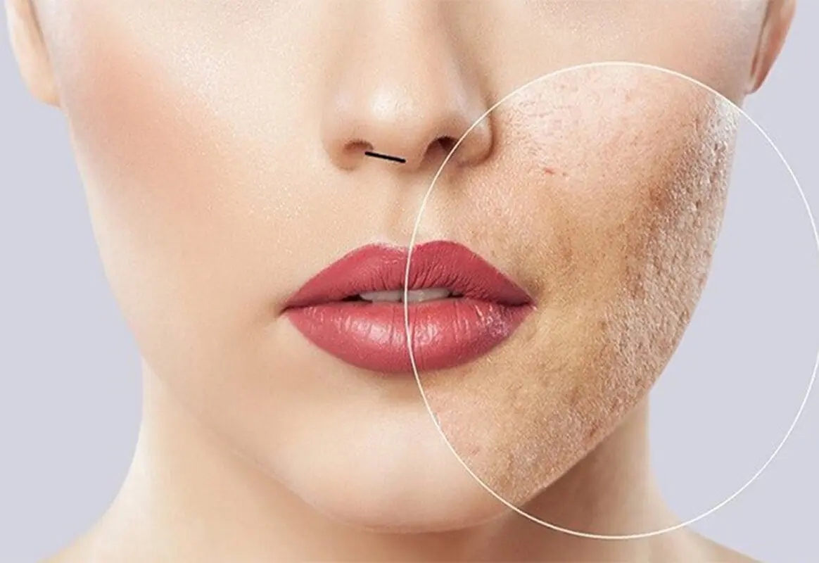 عوارض مزوتراپی صورت چیست؟