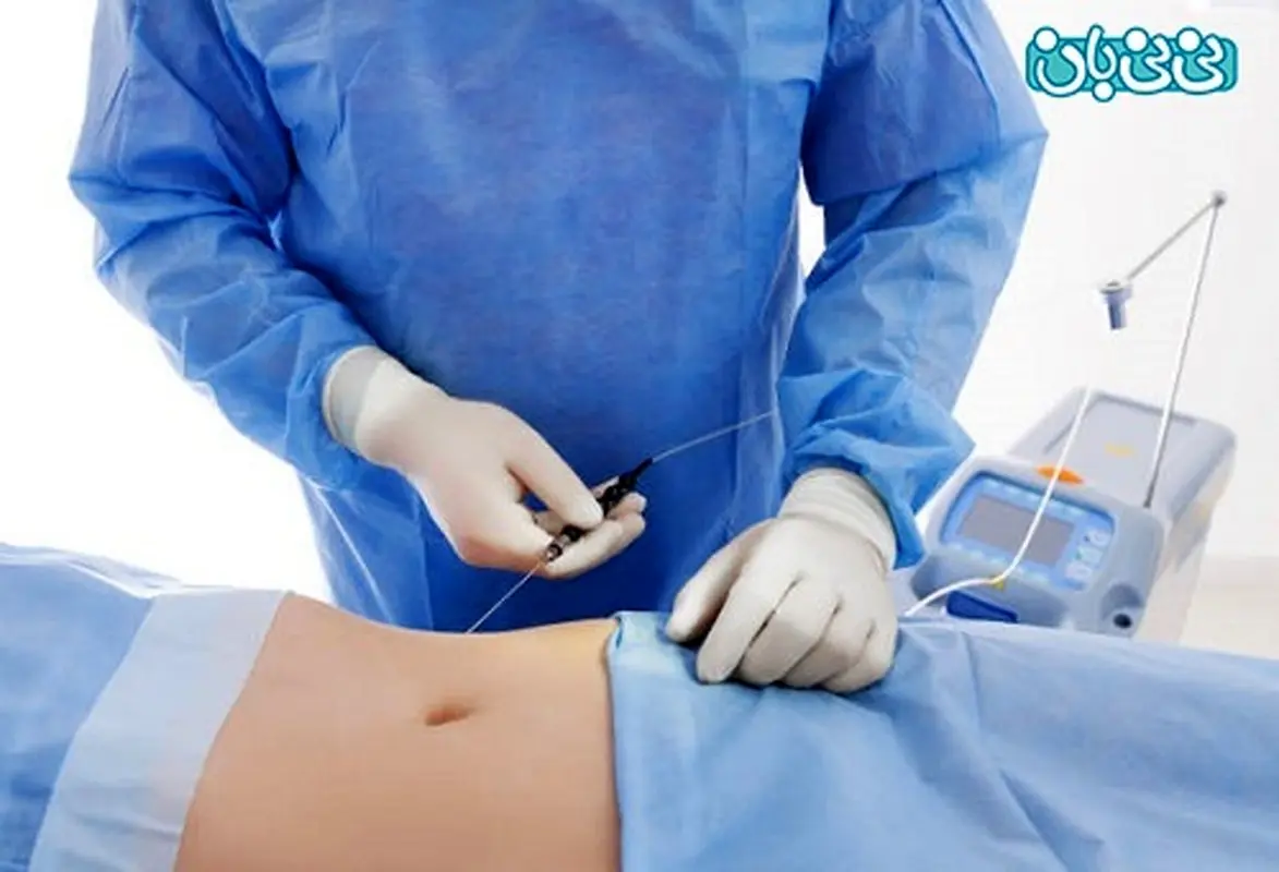 بهترین جراح لیپوماتیک خانم در تهران کیست؟