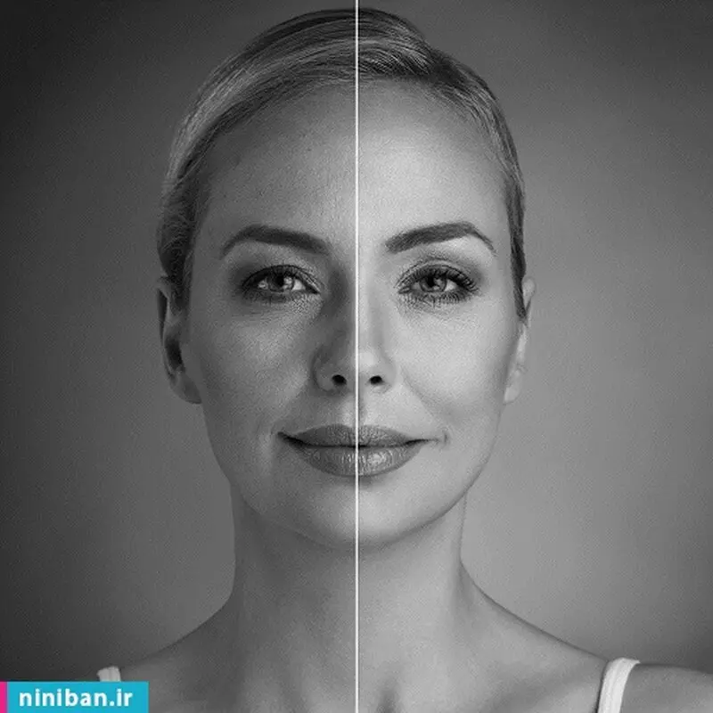 تزریق نانوفت صورت، چیست و چه عوارضی دارد؟