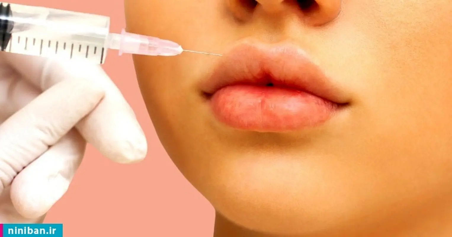 هزینه ژل لب مدل روسی 