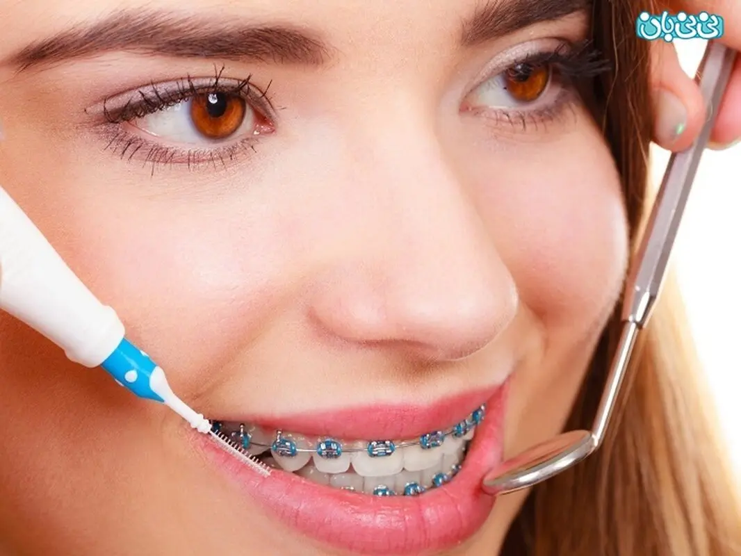 تاثیر ارتودنسی بر فک چیست؟ باعث تغییر شکل می‌شود؟