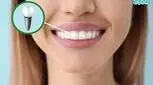 اوردنچر ایمپلنت چیست؟ کیفیت زندگی‌ات را بهبود بده!