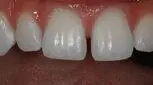 ضربه به دندان ‌های قدامی و راه‌های درمان