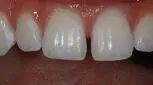 ضربه به دندان ‌های قدامی و راه‌های درمان