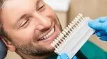 میزان تراش دندان برای لمینت، چقدر است؟