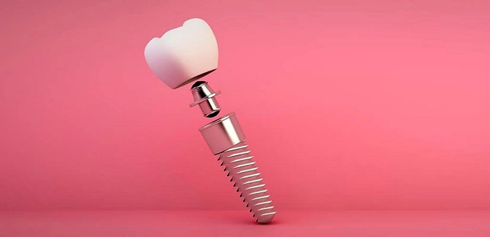 کاندیدای ایمپلنت دندان، این نکات را فراموش نکنید