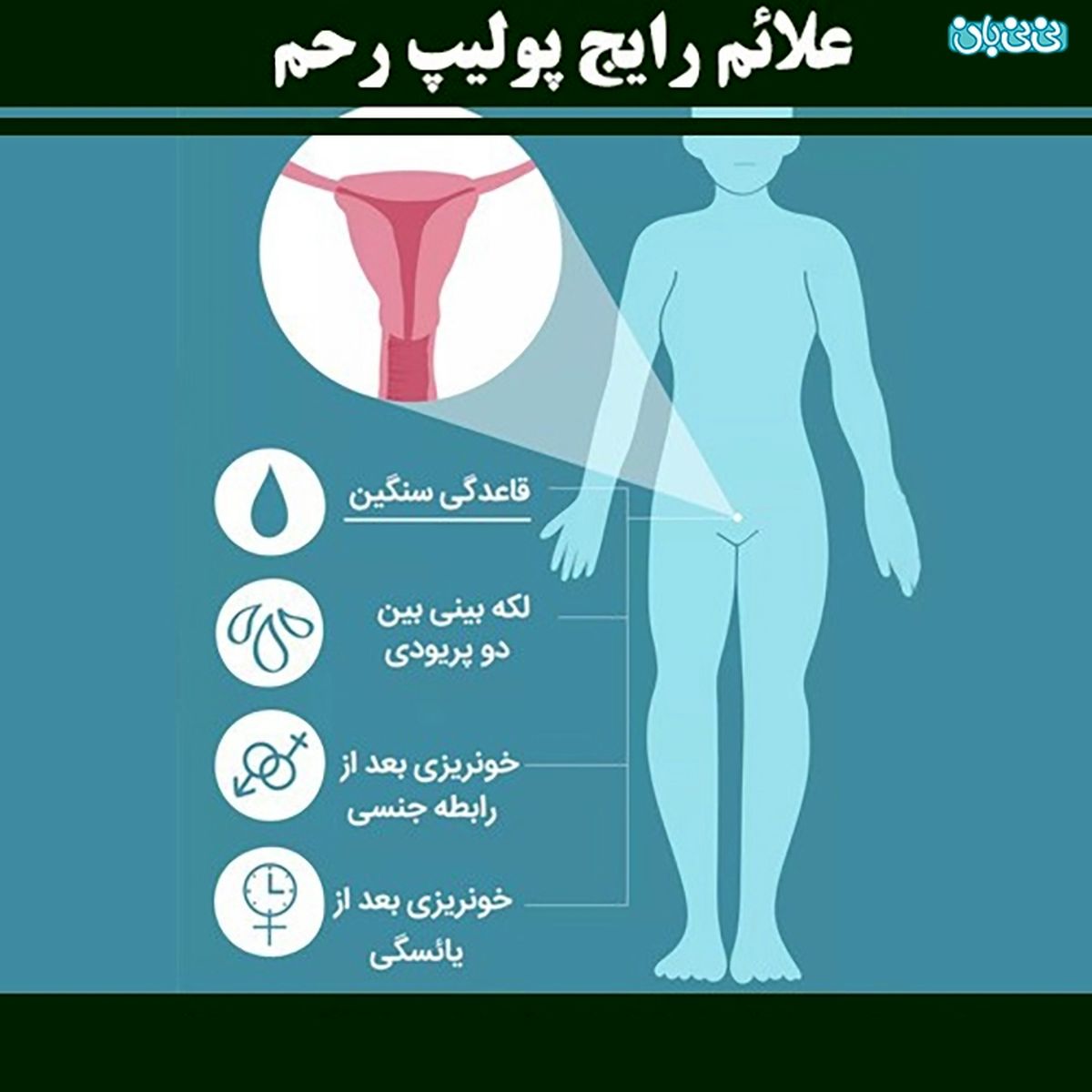 تاثیر پولیپ‌های رحمی روی باروری بانوان