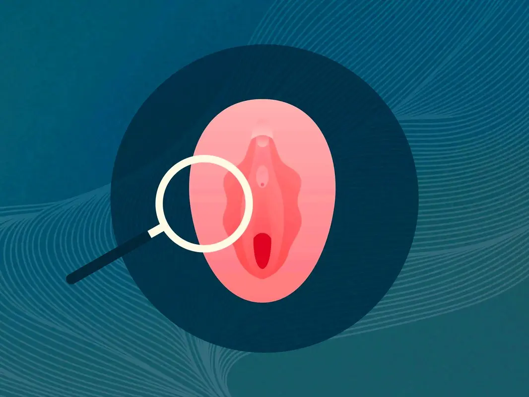 غربالگری دهانه رحم چیست؟