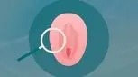 غربالگری دهانه رحم چیست؟