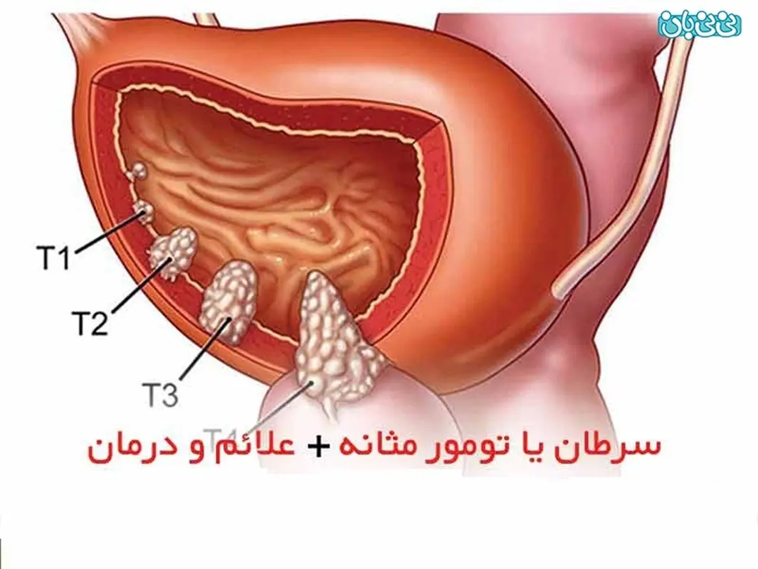 انواع سرطان های دستگاه ادراری- علل و درمان