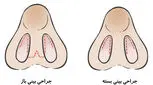 تفاوت رینوپلاستی باز و بسته، کدام بهتر است؟