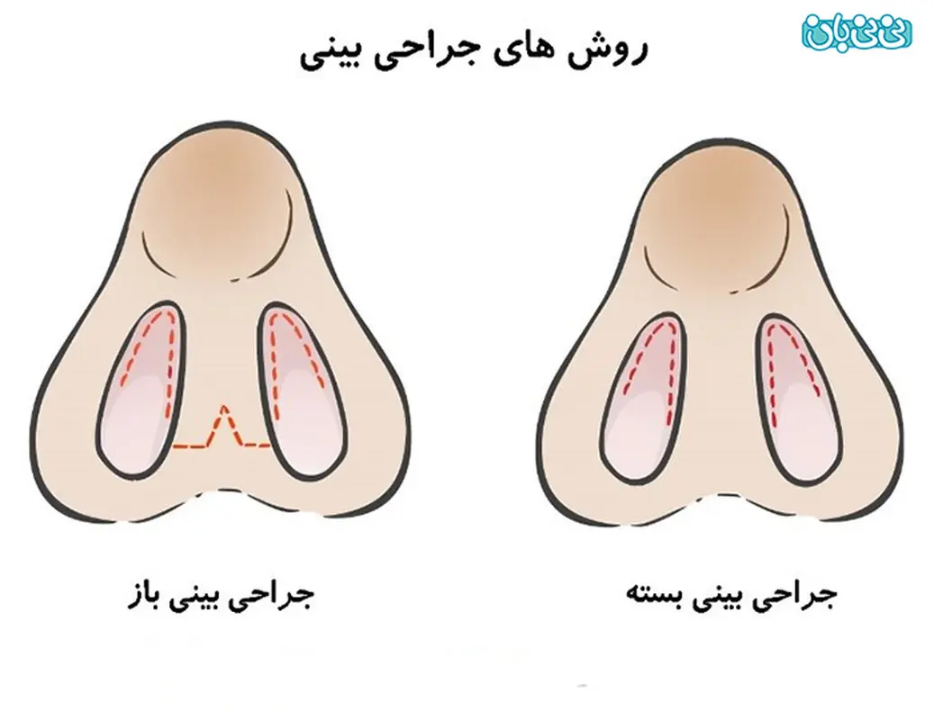 تفاوت رینوپلاستی باز و بسته، کدام بهتر است؟