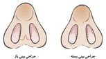 تفاوت رینوپلاستی باز و بسته، کدام بهتر است؟