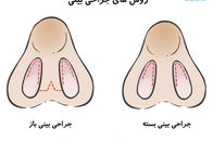 تفاوت رینوپلاستی باز و بسته، کدام بهتر است؟