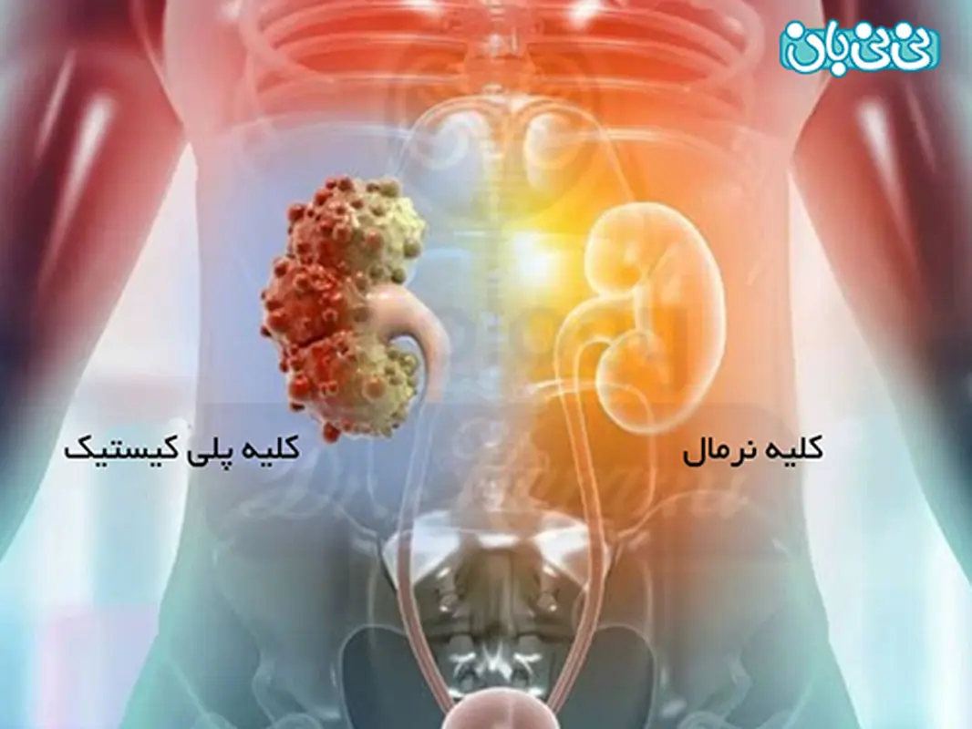درمان بیماری کلیه پلی کیستیک چیست؟