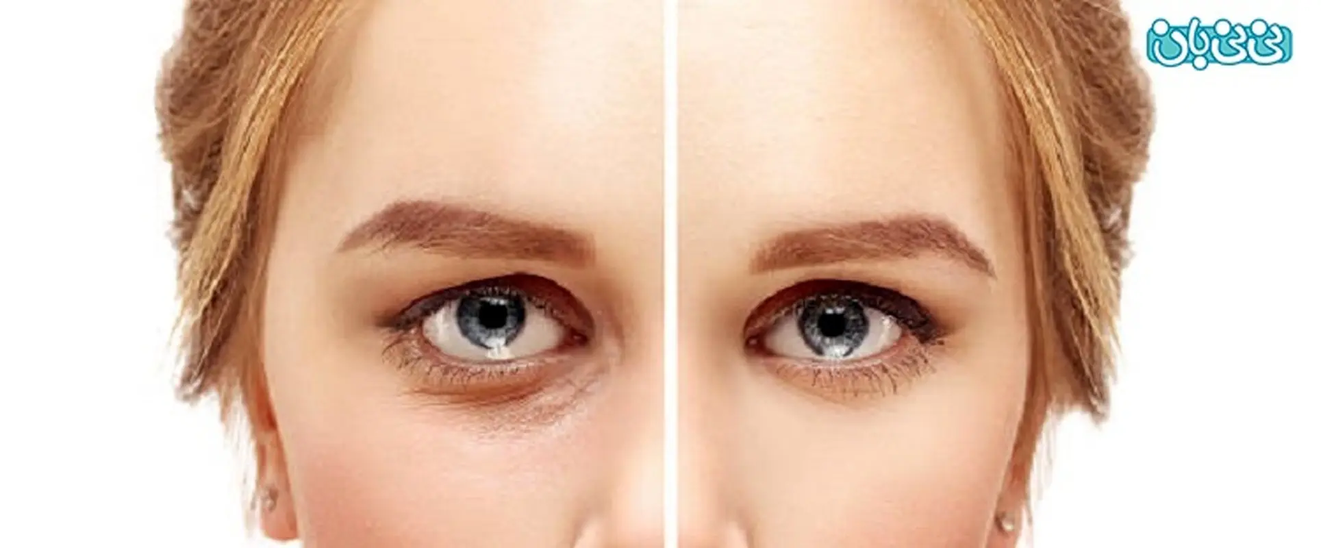 تزریق فیلر زیر چشم برای چه افرادی مناسب است؟