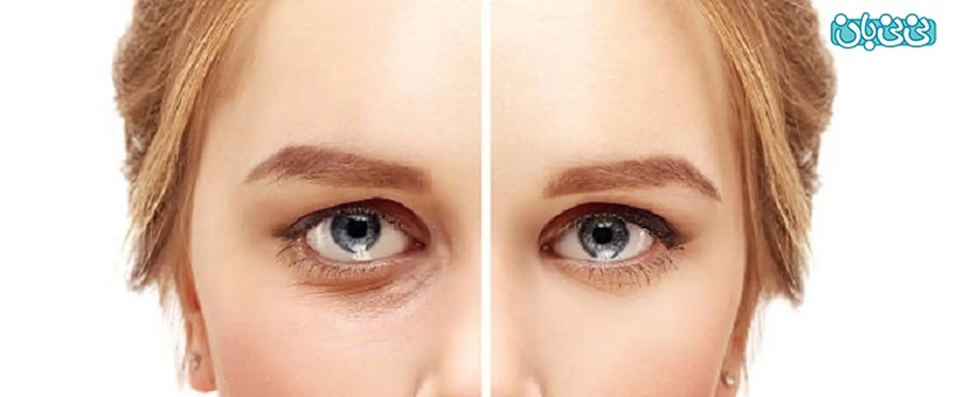 تزریق فیلر زیر چشم برای چه افرادی مناسب است؟