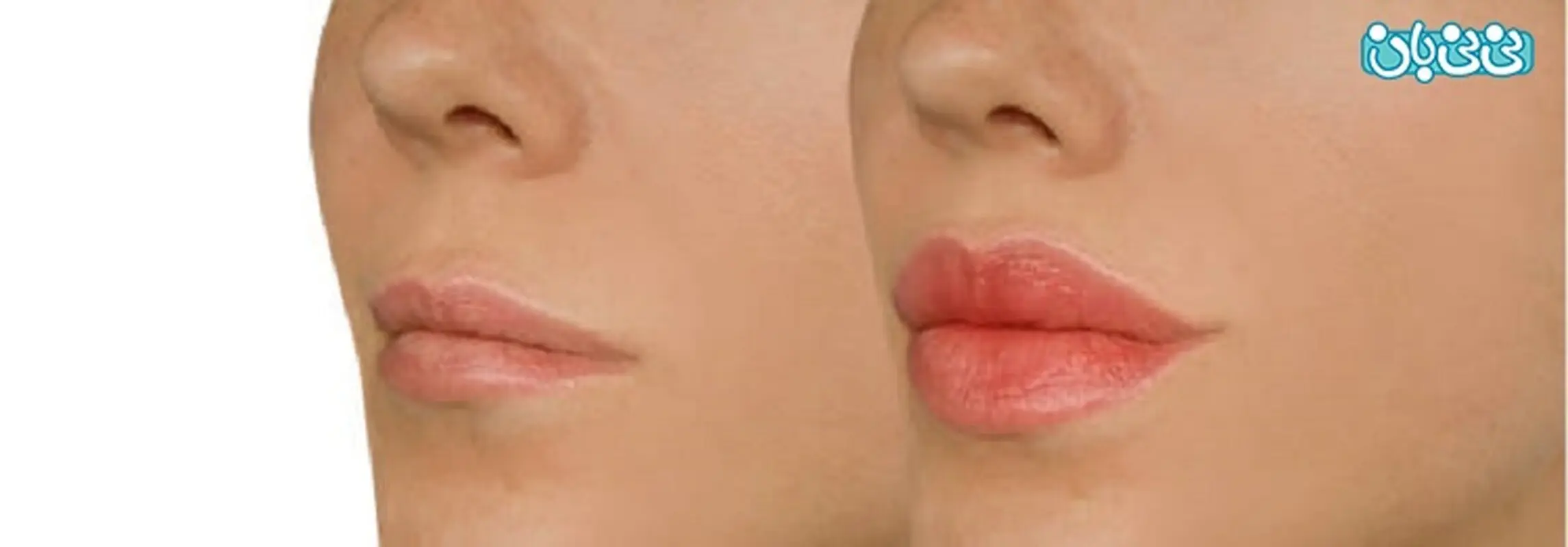 تزریق ژل لب مدل فانتزی چه نکاتی را رعایت کنیم؟