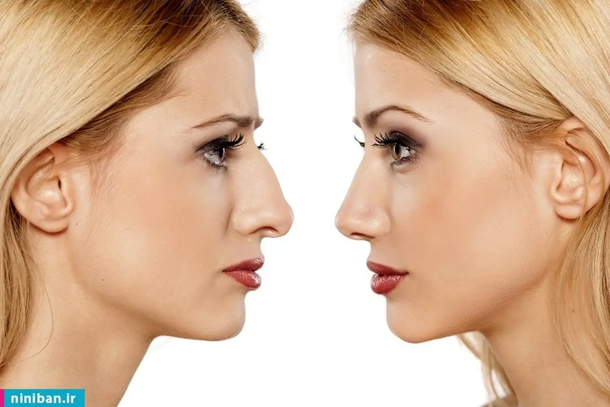 لیفت بینی با نخ بهتر است یا ژل؟