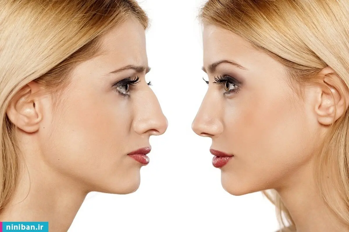 لیفت بینی با نخ بهتر است یا ژل؟