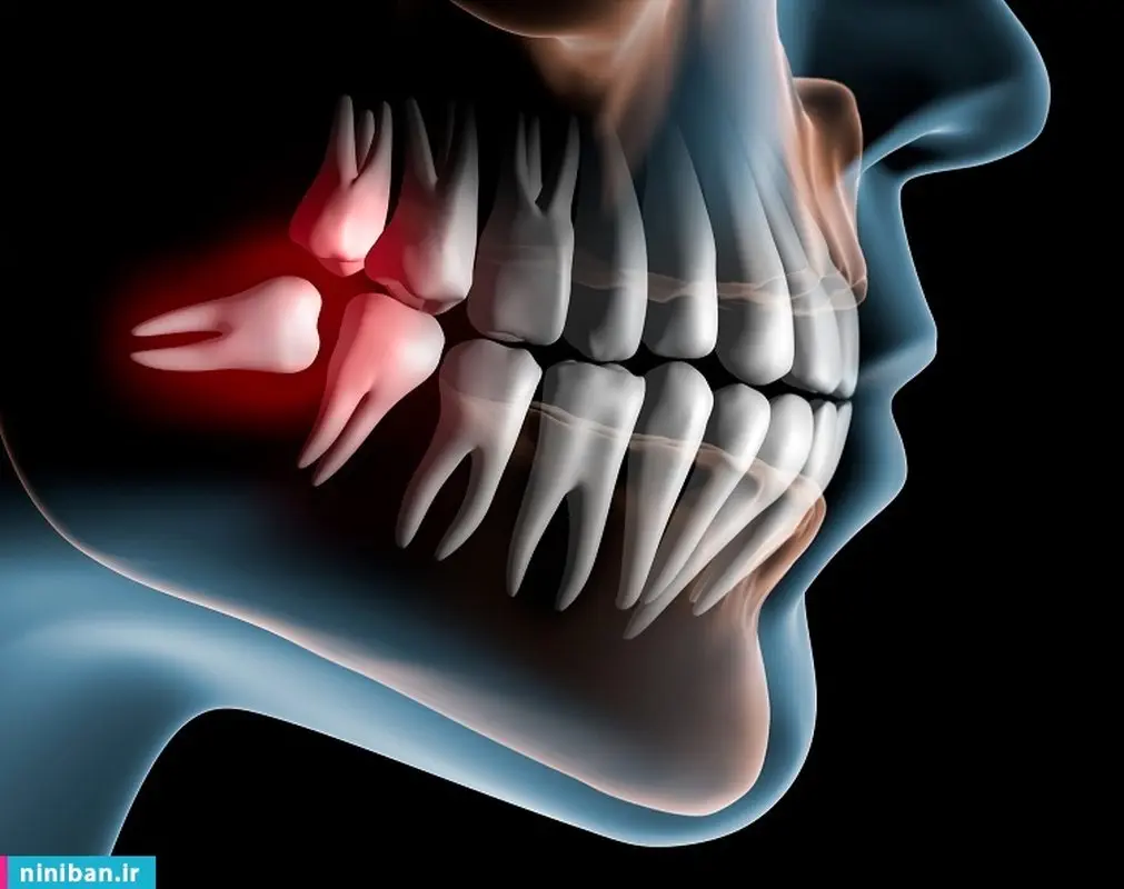 دوره نقاهت جراحی دندان عقل چگونه است؟