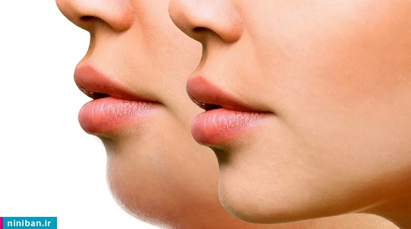 عمل زیبایی چانه بدون جراحی با تزریق چربی