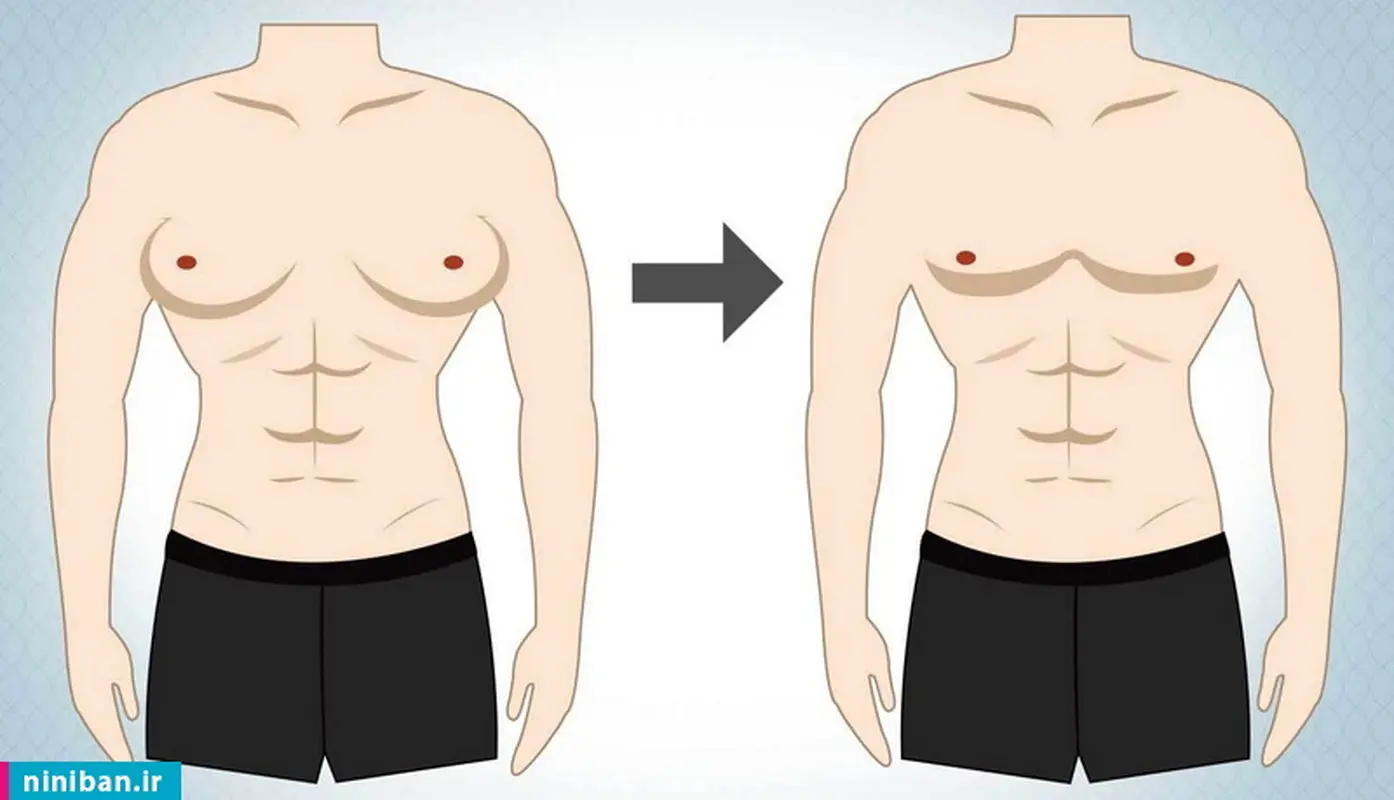 هزینه درمان ژنیکوماستی در مردان چقدر است؟