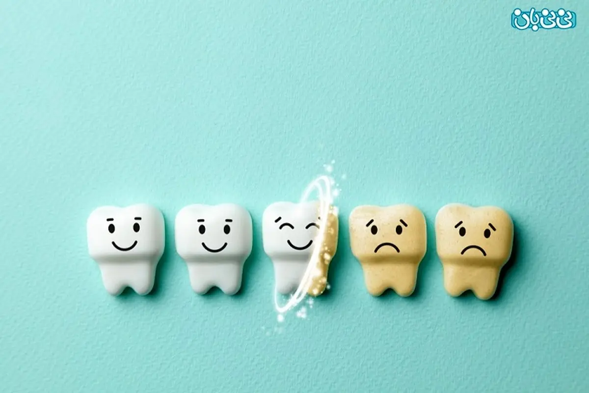 بلیچینگ مطبی، بررسی کامل مزایا و معایب