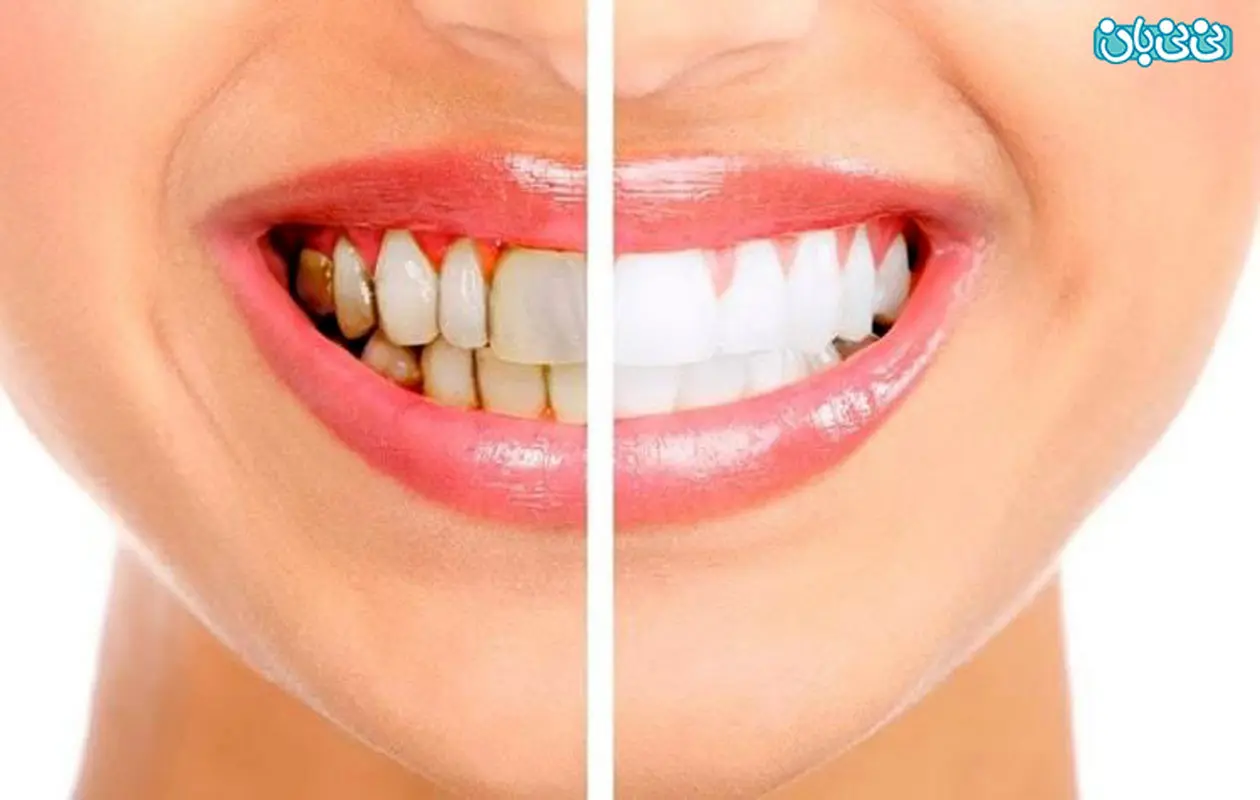 انواع بلیچینگ دندان، کدام یک بهتر است؟