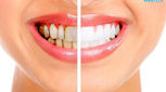 انواع بلیچینگ دندان، کدام یک بهتر است؟
