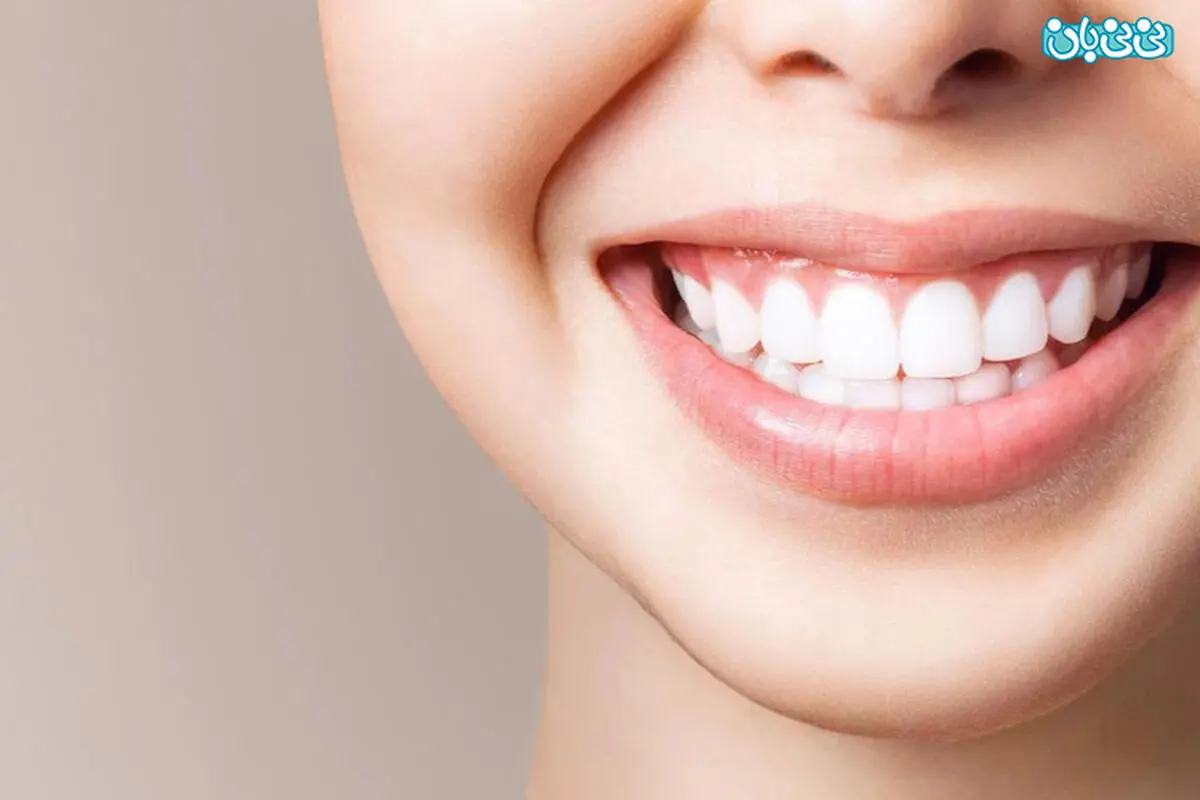 فرق لمینت با بلیچینگ چیست؟ بررسی مزایا و معایب