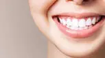 فرق لمینت با بلیچینگ چیست؟ بررسی مزایا و معایب