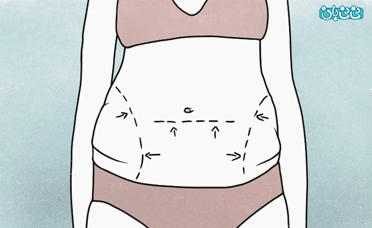 بهترین روش جراحی برای لاغری شکم و پهلو، مقایسه کامل برای رفع ابهامات