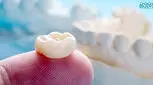 همه چیز درباره روکش دندان!