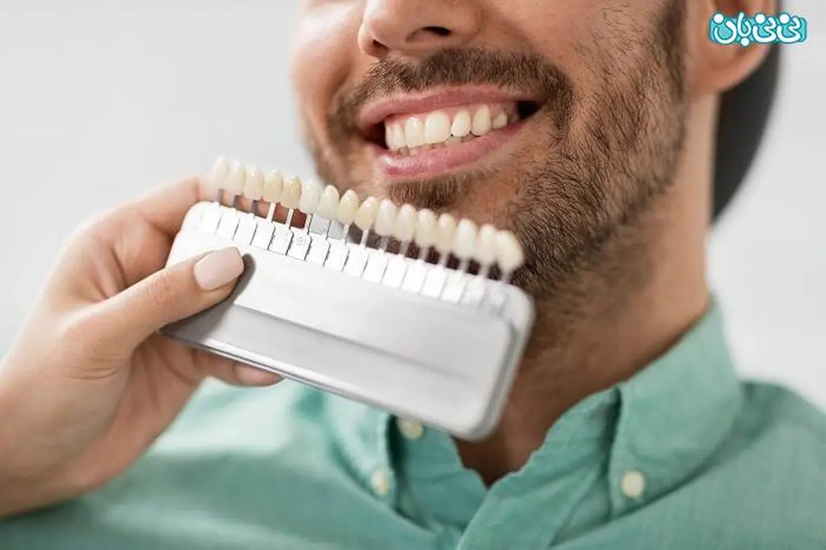 کامپوزیت ونیر و لمینت طبیعی، تفاوت‌ها و مزایا و معایب