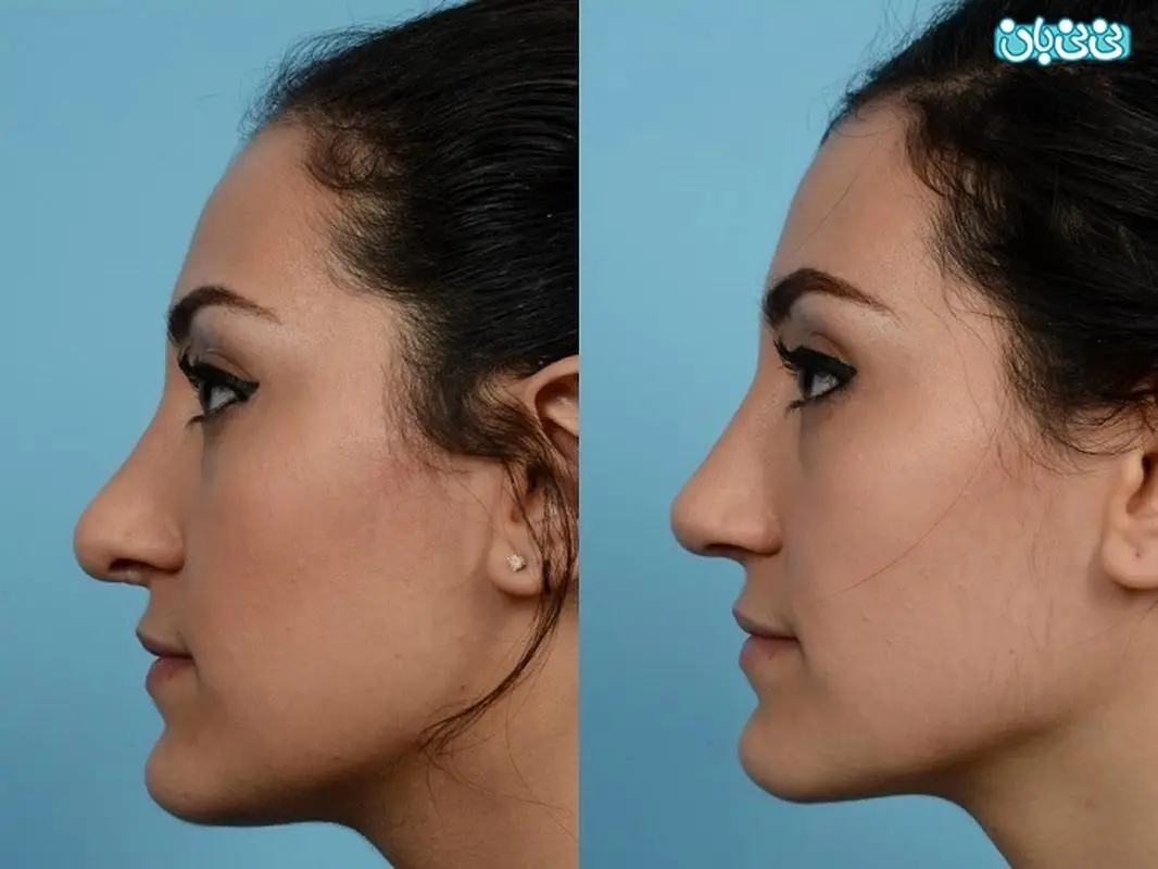 ترمیم بینی جراحی شده؛ خطرات و مراقبت ها