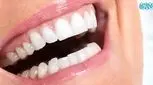 اصلاح طرح لبخند لثه ای با تزریق بوتاکس و ژل