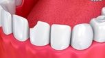 ترمیم دندان چیست؟ یک راهنمای کامل